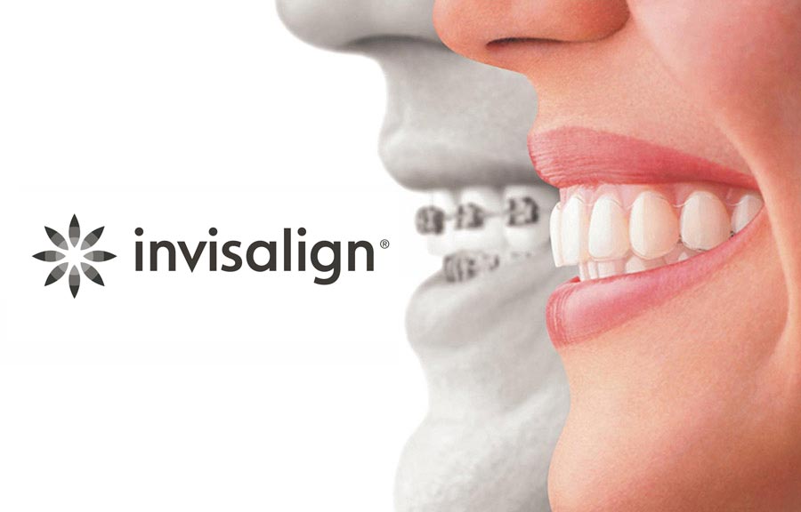 Invisalign; Invisible braces for the perfect smile. Finance Available