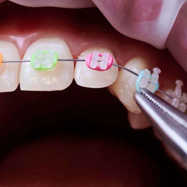 How to change the colorful rubber bands for orthodontics. Make sure to, Rubber Band Braces